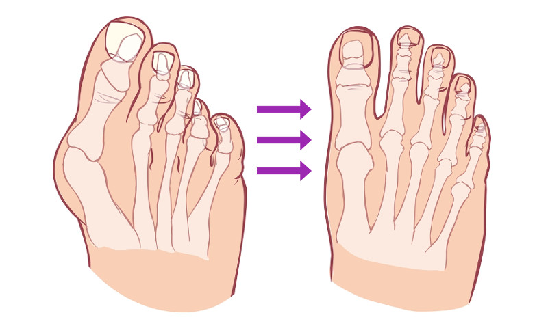Удаление «косточки» у большого пальца ноги: методика доктора Цуканова