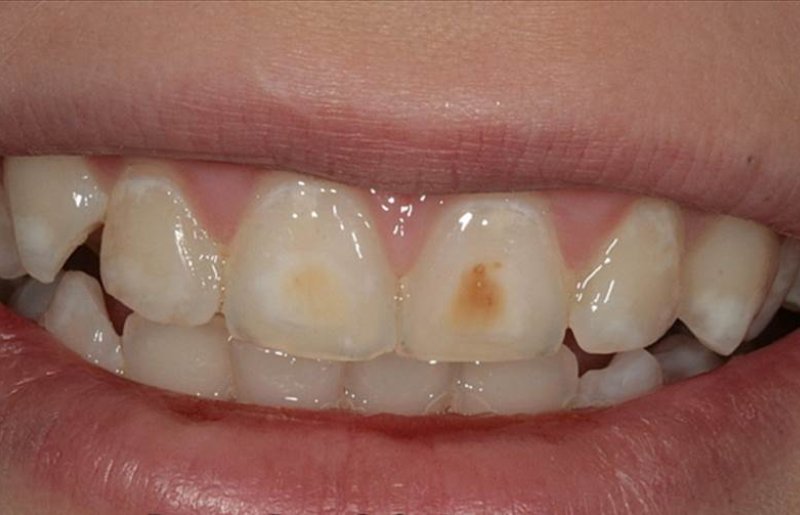 Пятна на зубах лечение в домашних условиях