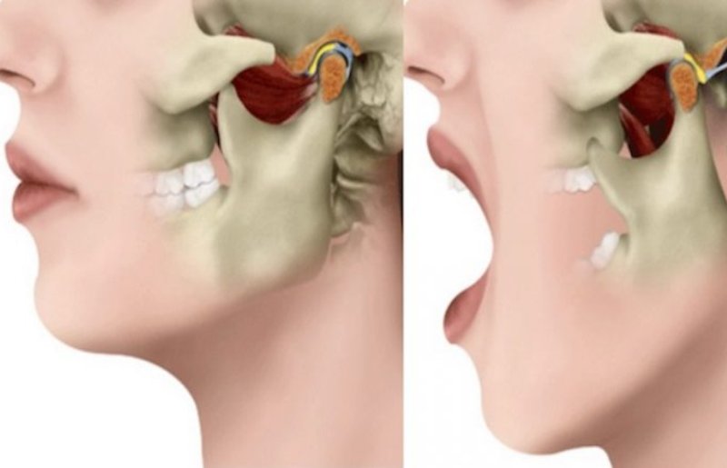 Хруст и боль в области уха (заболевания височно-нижнечелюстного сустава)