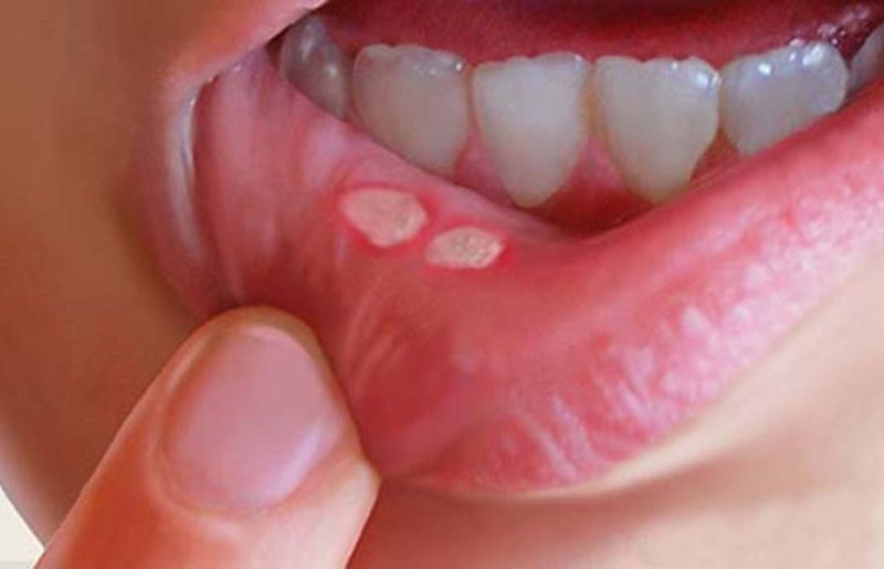 Язвочки во рту. Откуда берутся язвочки во рту? Лечение язвочек во рту