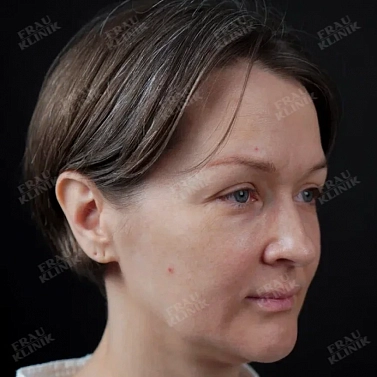 Пластика верхних век