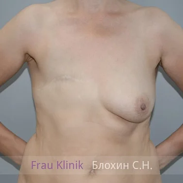 Реконструкция после мастэктомии