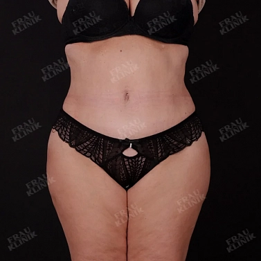 Абдоминопластика + липомоделирование