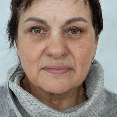 Пластика век