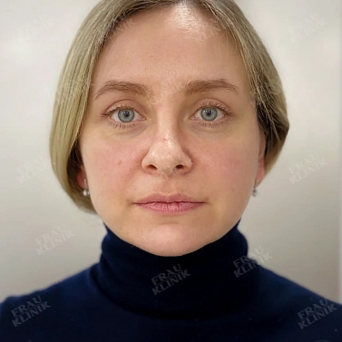 Пластика верхних век