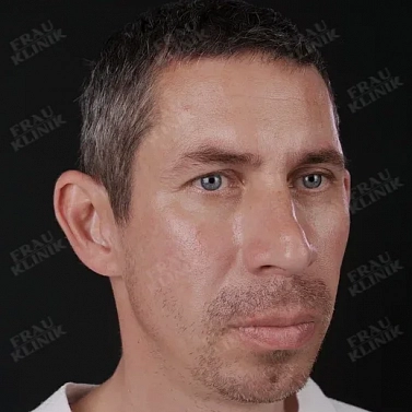 Пластика ушей