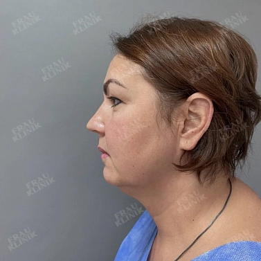 Фейслифтинг