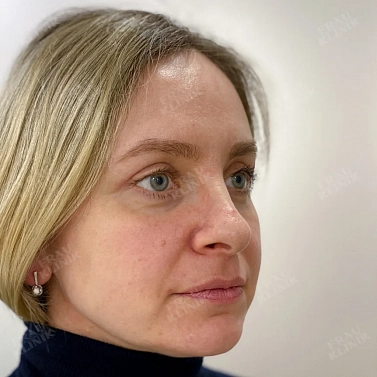 Пластика верхних век