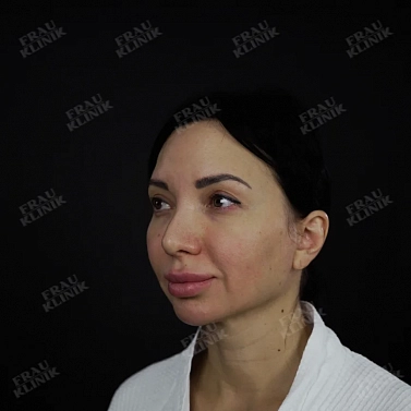 Височный лифтинг