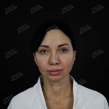 Височный лифтинг