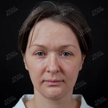 Пластика верхних век