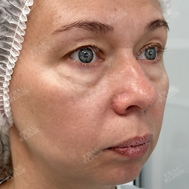 Круговая пластика век