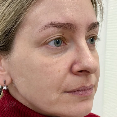 Пластика верхних век