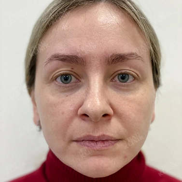 Пластика верхних век