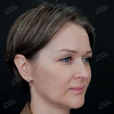 Пластика верхних век