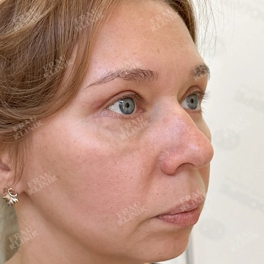 Круговая пластика век