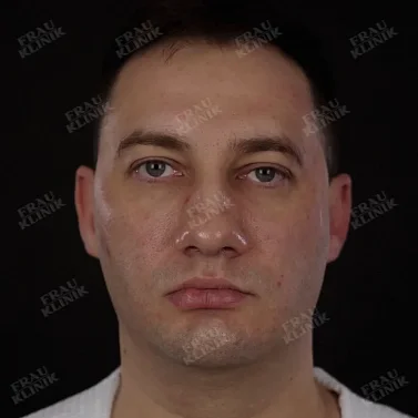 Фейслифтинг