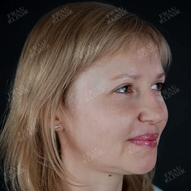 Пластика верхних век