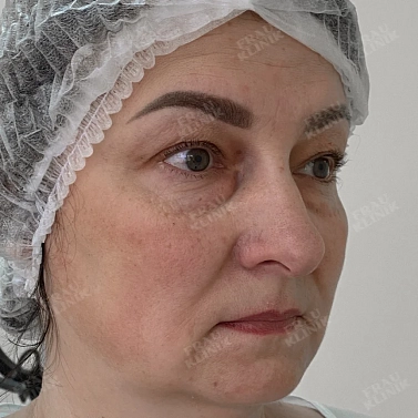 Круговая пластика век