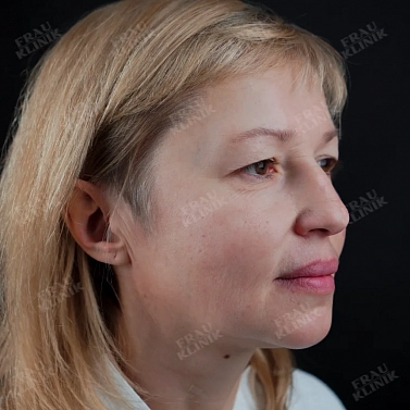 Пластика верхних век