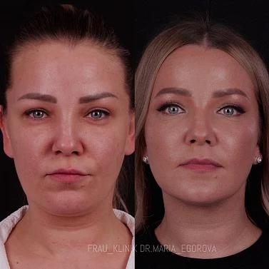 Липосакция подбородка