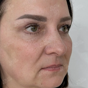 Круговая пластика век