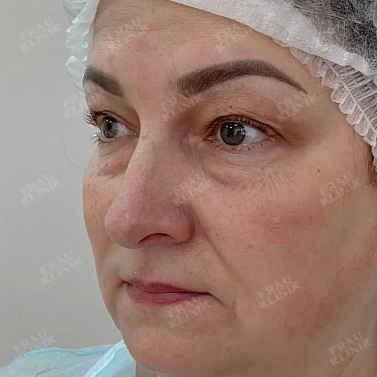 Круговая пластика век