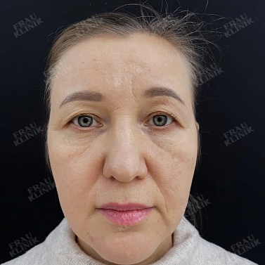 Миотокс