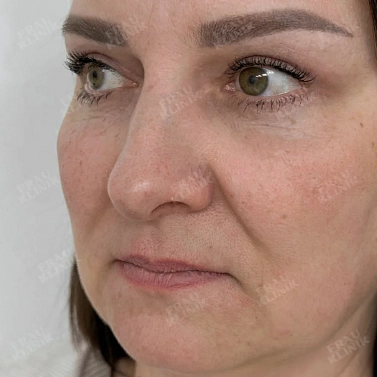 Круговая пластика век