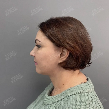 Фейслифтинг