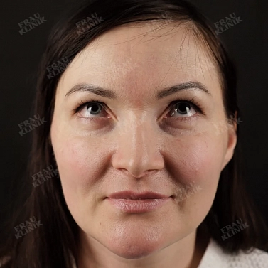 Пластика век