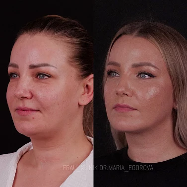 Липосакция подбородка