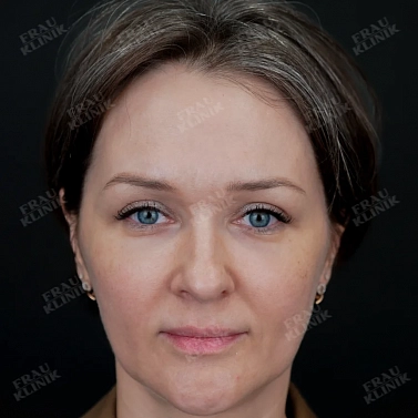 Пластика верхних век