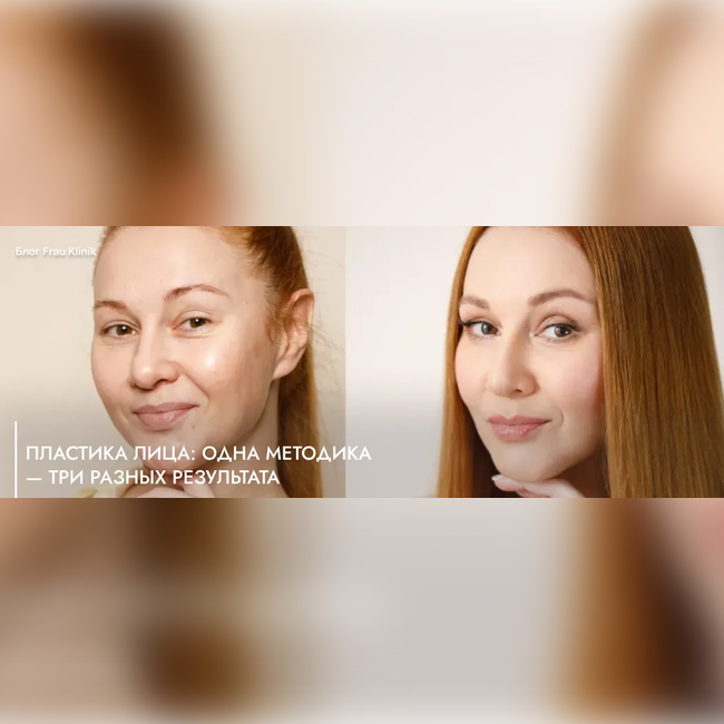 Пластика лица: одна методика — три разных результата