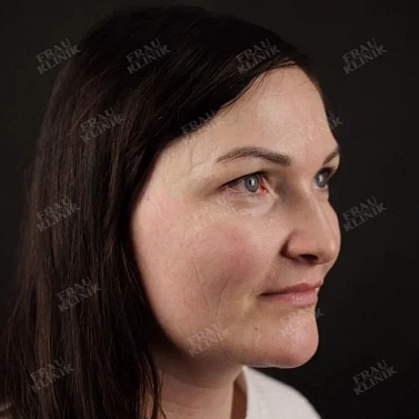 Пластика век