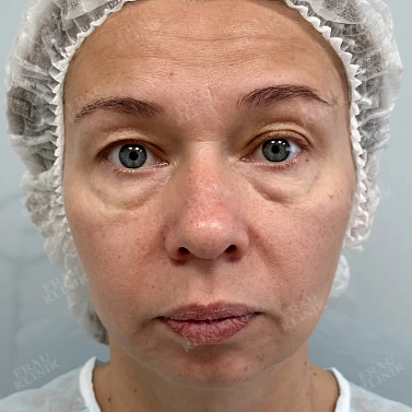 Круговая пластика век