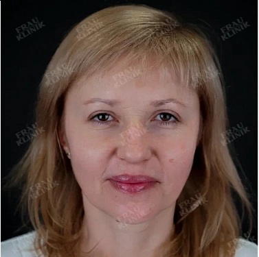 Пластика верхних век