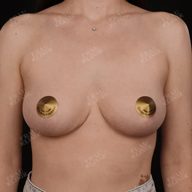 Редукционная маммопластика