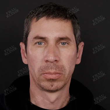 Пластика ушей