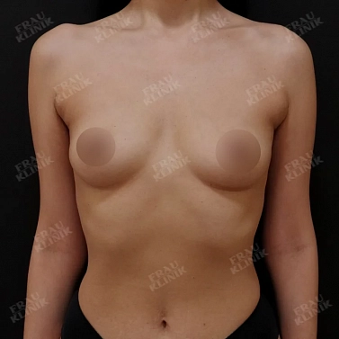 Увеличение груди