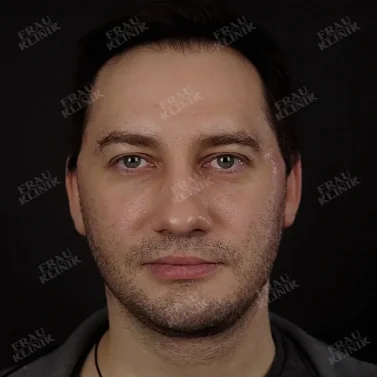 Фейслифтинг