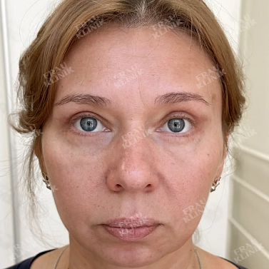 Круговая пластика век