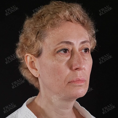 Пластика век