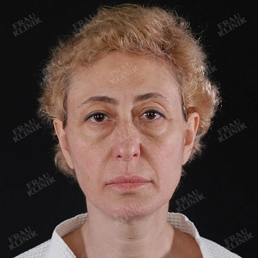 Пластика век