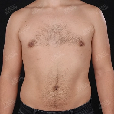 Мастэктомия