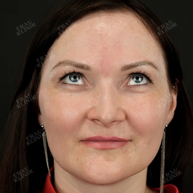 Пластика век