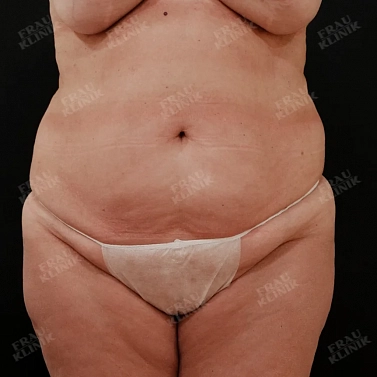 Абдоминопластика + липомоделирование