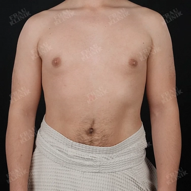 Мастэктомия