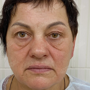 Пластика век