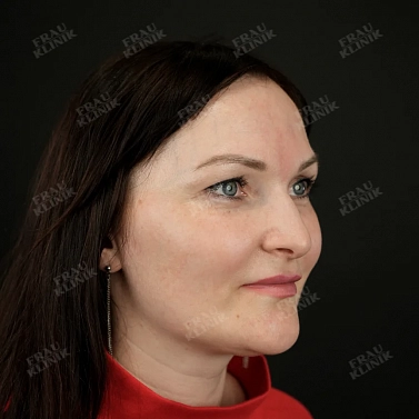 Пластика век